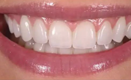 不同类型全瓷牙套的特点对比