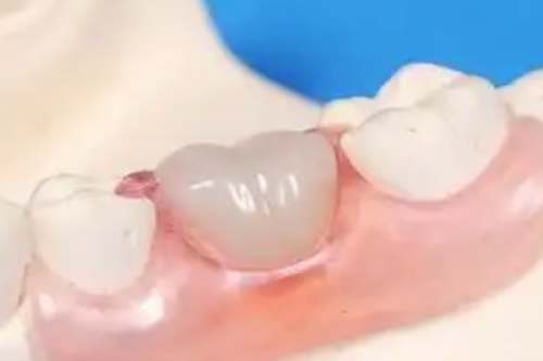 不同补牙材料的进食时间