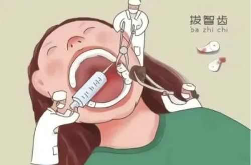 拔牙后的护理要点