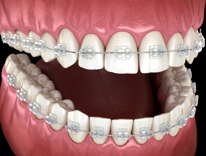 牙齿矫正可以走医保吗？揭秘2026年最新政策！