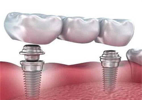 延长种植牙寿命的维护建议