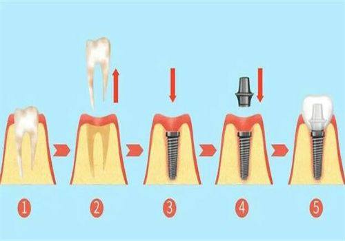 如何选择适合自己的种植牙材料