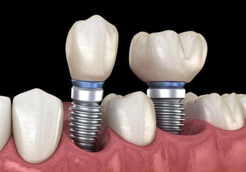 咬合习惯与全身健康:不可忽视的影响因素