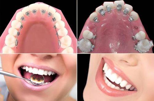 牙齿矫正的注意事项
