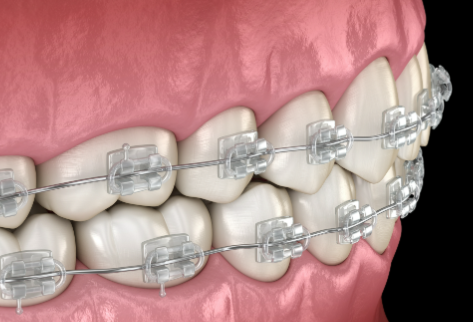 隐形矫正：美观舒适的选择