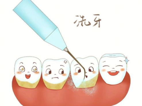 洗牙后的注意事项