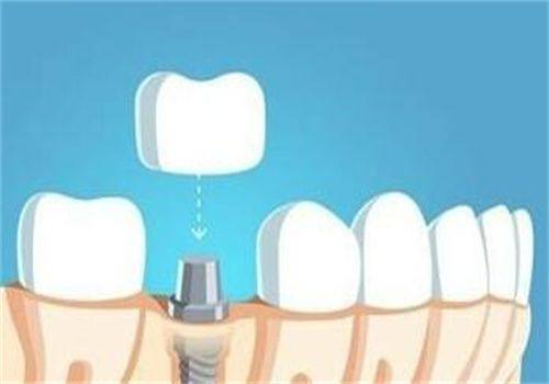 为什么40岁后不建议种牙？了解这5大潜在风险！