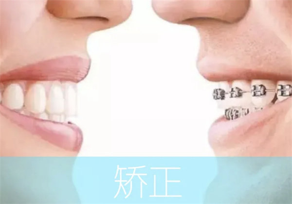 牙齿矫正有几种方法及费用？全面解析让你轻松选择！