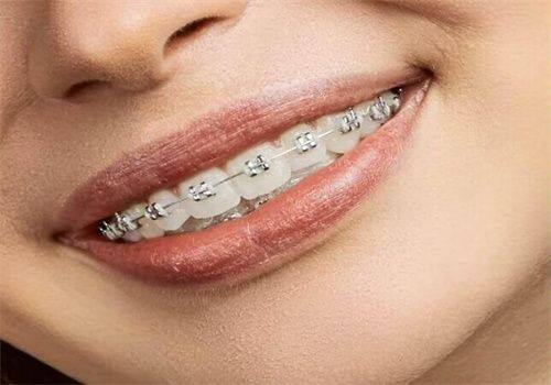 牙列畸形度因素：畸形越重度费用越高