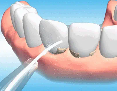 洗牙会不会损害牙齿？揭秘3大真相，保护你的口腔健康！