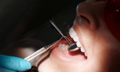 洗牙后需要忌口的食物