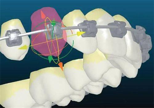 如何判断是否可以摘掉牙套