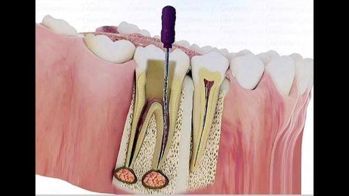牙科根管治疗一般多少钱？了解真实费用，避免不必要的支出！