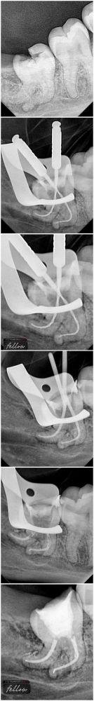 根管治疗分几个步骤？揭秘完整流程与注意事项！