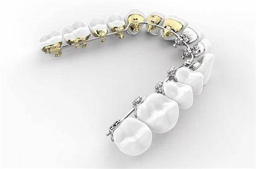 成年人矫正牙齿的特点