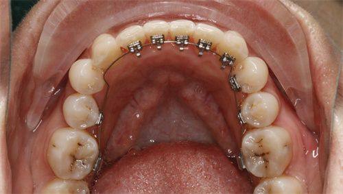 不同年龄段矫正牙齿需要注意什么？