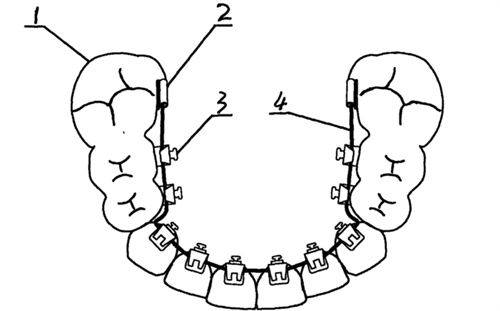 恒牙早期矫正：11 - 14岁的效率高矫治