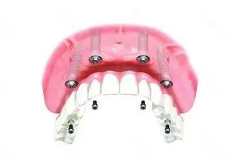 如何减轻种牙疼痛？