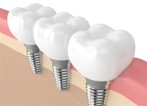 种牙第一次手术一般疼几天？详解恢复过程与缓解方法！