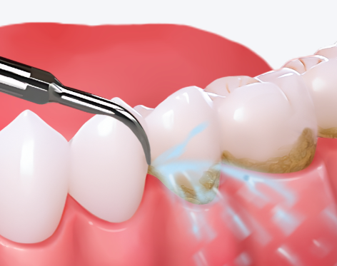 洗牙所需的时间