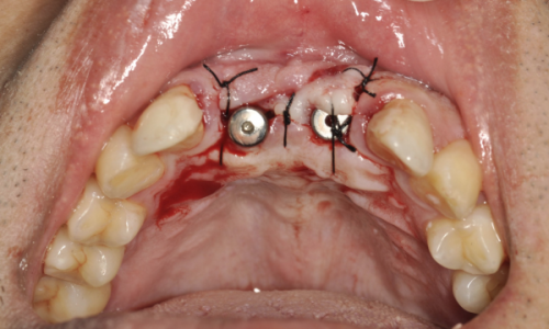 种植牙的使用寿命一般是多久？揭秘持久美齿的秘密！