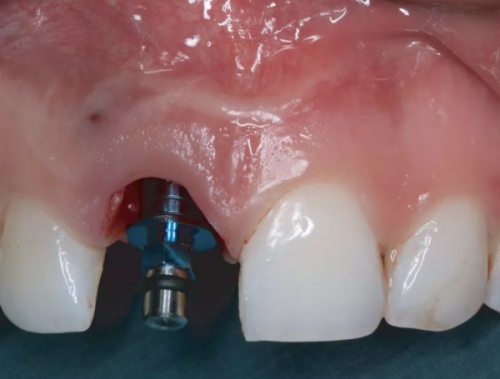 种植牙的适用情况