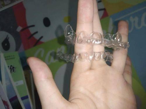 牙套价格一般是多少钱一个进口？全面解析与真实案例分享！