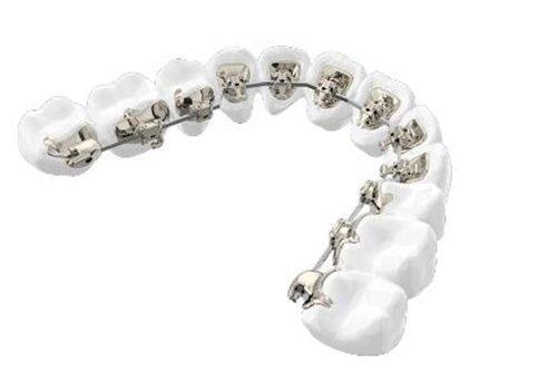 成人牙齿矫正费用情况