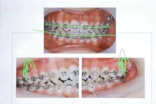 影响牙齿矫正费用的其他因素