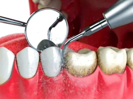 洗牙后多久可以吃东西喝水？3个注意事项让你安心！