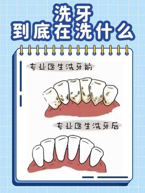 洗牙后为何要忌口