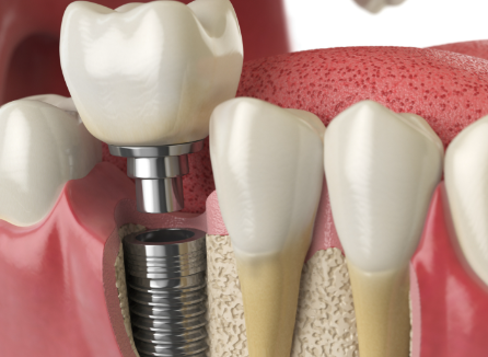 即刻负重手术的优势与时间