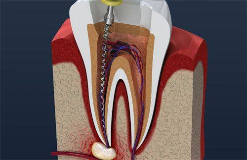 根管治疗后是不是就是死牙了？揭秘真相与护理建议！
