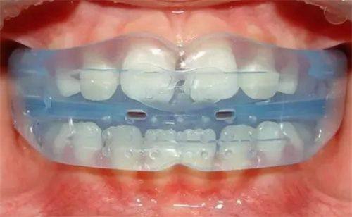 成人整牙的挑战与优势