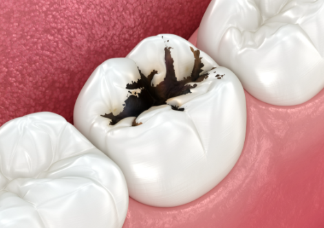 龋齿停止腐蚀还用补吗？揭示真相与你牙齿健康的秘密！