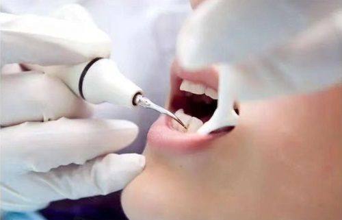 洗牙有助于维护全身健康
