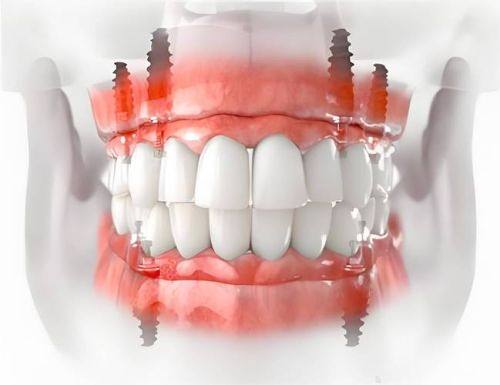 种植牙后饮食有讲究，硬东西能吃吗