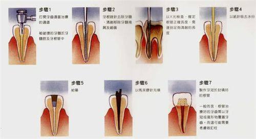 活髓牙或牙髓炎的痛苦体验