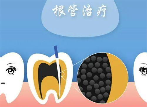 根管充填与后期修复：巩固疗效，保护牙齿