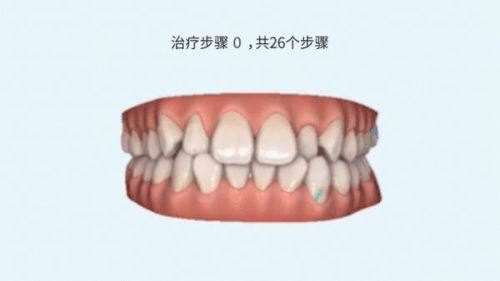 传统金属矫正器：经济实用之选