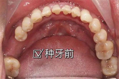 种植牙使用年限的真实实例