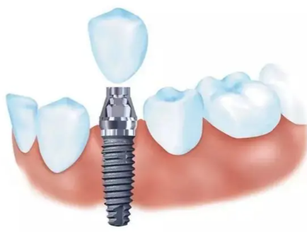 种植牙一颗大概多少钱？2026年费用全解析！
