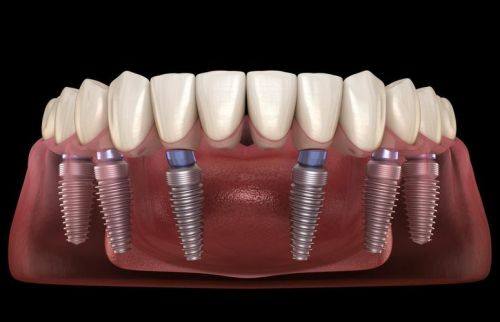 种植牙可以用多久？揭秘其使用寿命及维护秘诀！