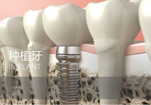 延长种植牙使用寿命的建议