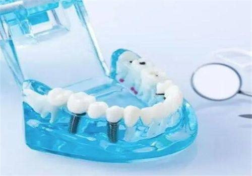 揭秘种植牙流程：5个步骤让你重拾自信微笑！