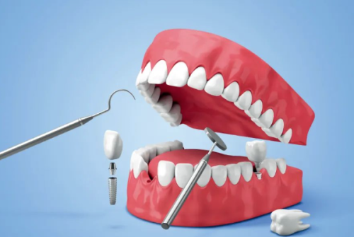 未正确使用和维护使种植牙寿命缩短的原因