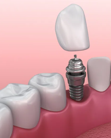 如何判断种植牙是否需要就医