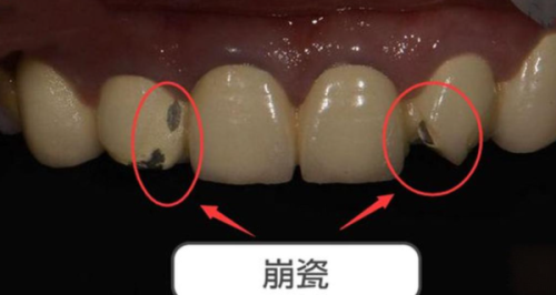 如何判断全烤瓷牙套是否需要更换