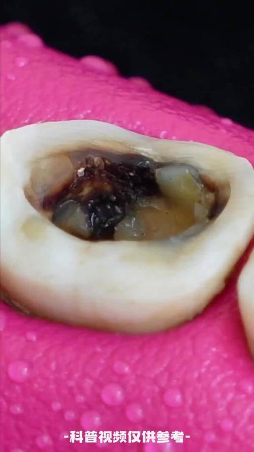 龋齿是什么原因造成的？5种有效治疗方法揭秘！