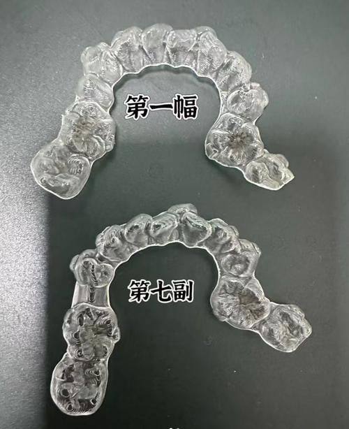 佩戴牙套的注意事项